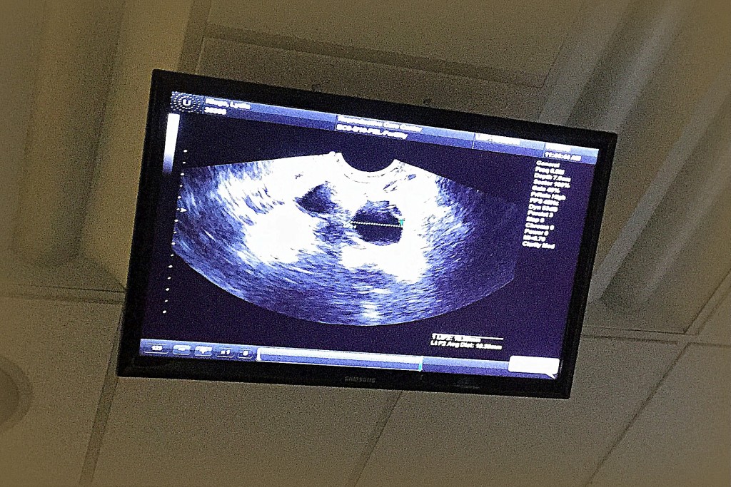 We have ultrasounds every other day or daily to monitor the size of the follicles. The follicles look like large dark spheres on the ovaries.